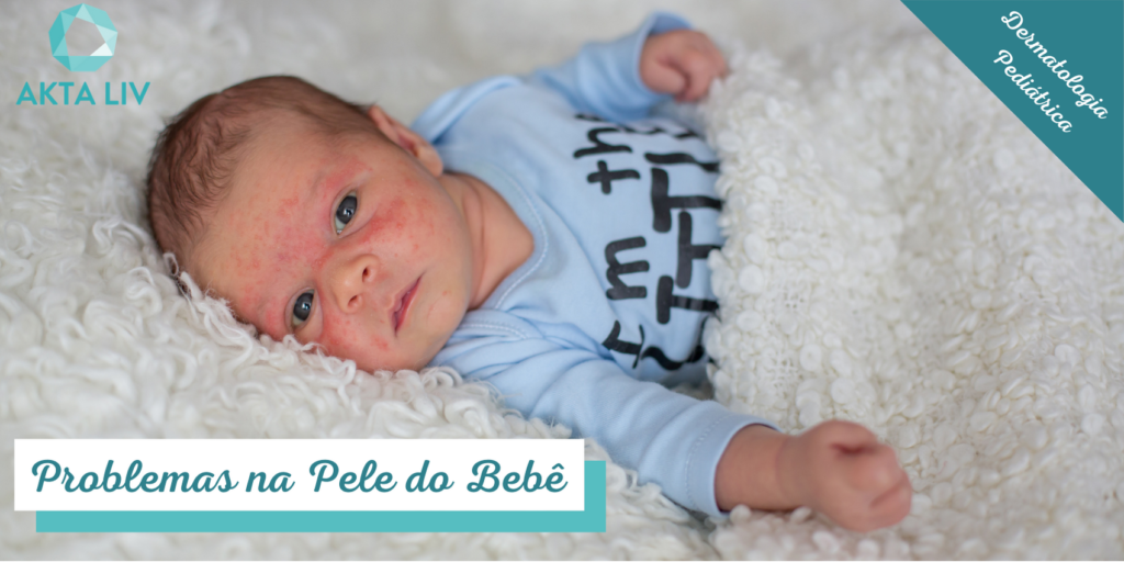AKTA-Liv-Dermatologia-Problemas-na-Pele-do-Bebe-Blog