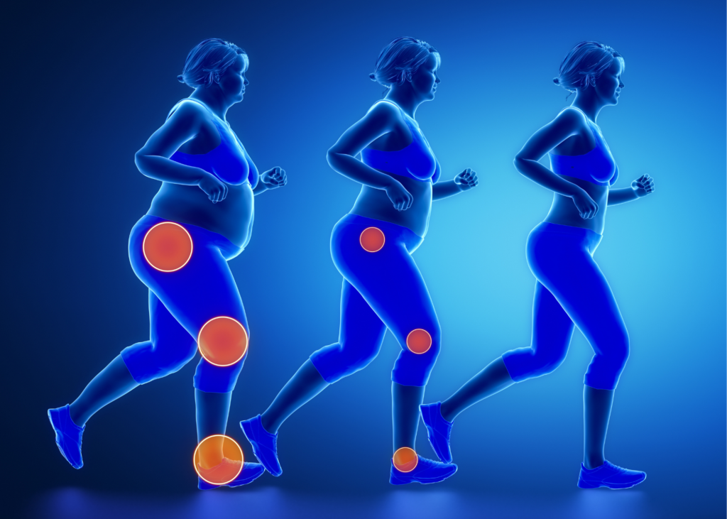 AKTA-Liv-fisioterapia-obesidade-dores-articulacoes
