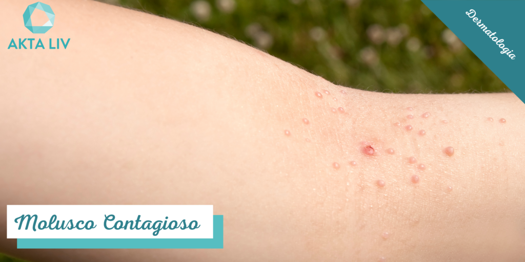 AKTA-Liv-Dermatologia-Molusco-contagioso