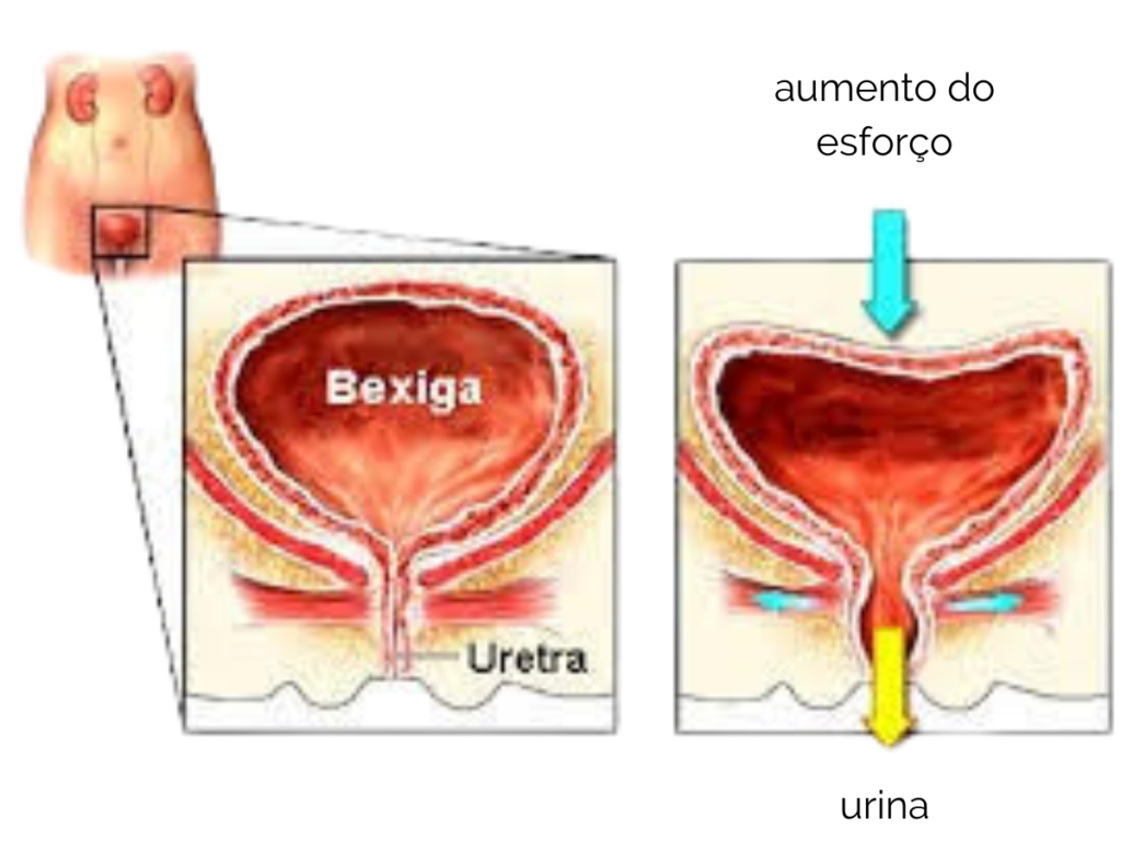 AKTA-Liv-Endocrinologia-Integrada-fisioterapia-pelvica-incontinencia-urinaria-feminina-aumento-do-esforco