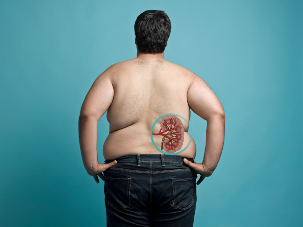 AKTA-Liv-Endocrinologia-Urologia-pessoas-obesas-tem-mais-calculos-renais-homem-obeso-imagem-do-rim